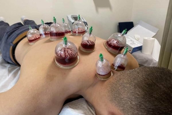 Cupping Therapy